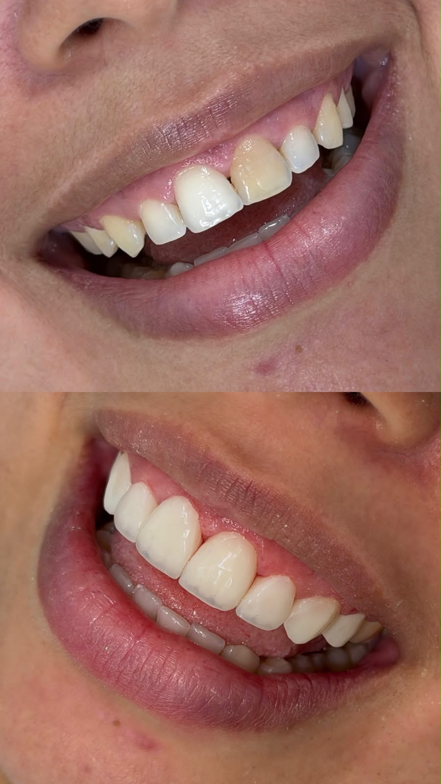Caso de reabilitação estética 2 — antes e depois