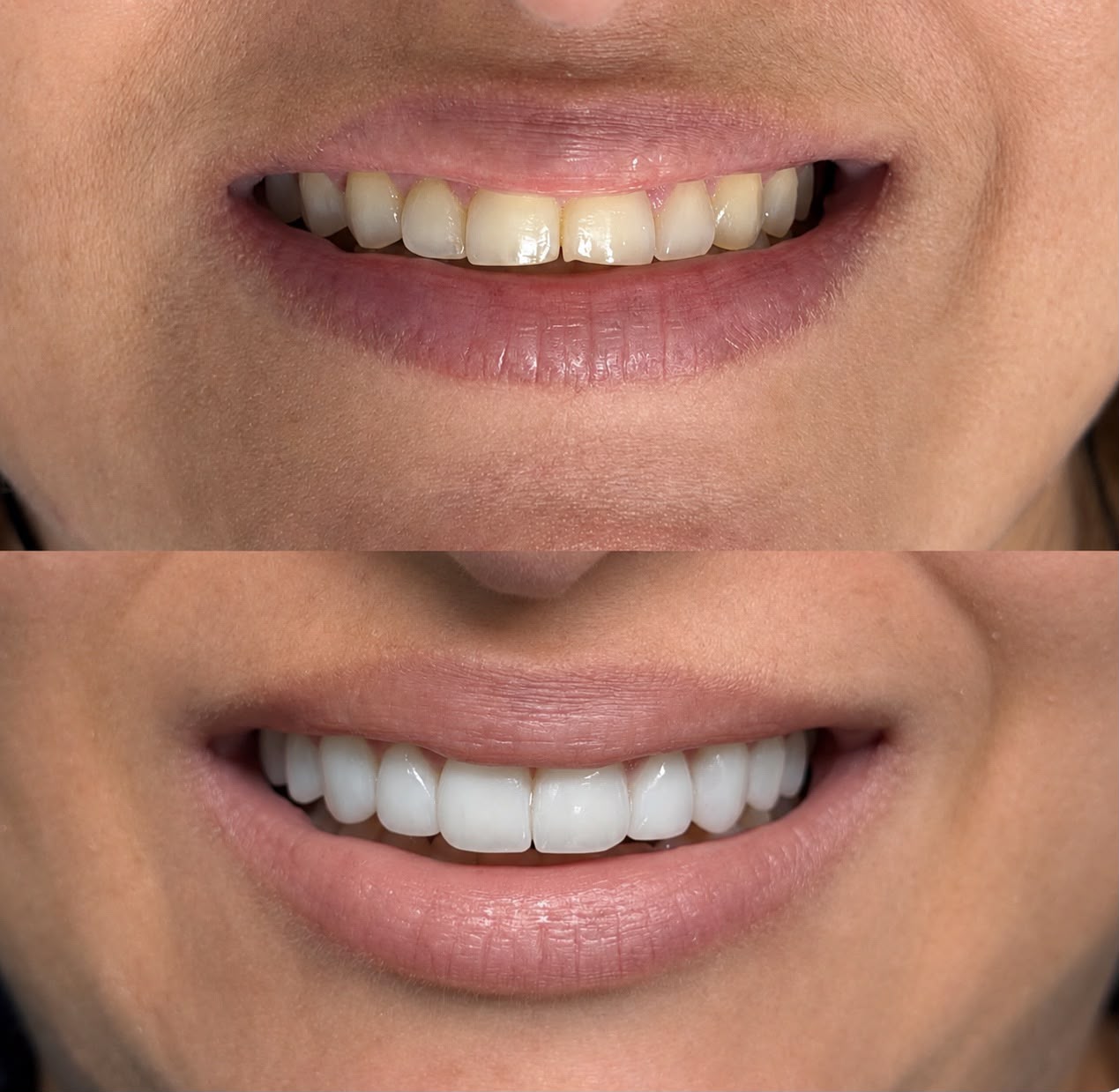 Caso de reabilitação estética 1 — antes e depois